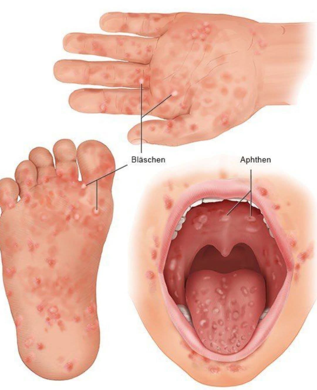 &nbsp;أعراض فيروس HFMD&nbsp;