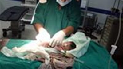 بالصور.. ولادة طفلة بأحشاء خارج جسدها فى حالة نادرة بالعريش