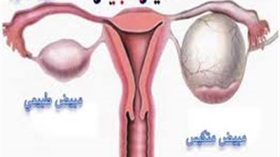 أخصائي تغذية علاجية: السمنة تسبب تكيس المبايض