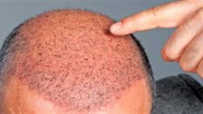 زراعة الشعر بالاقتطاف غير مؤلمة ونتائجها جيدة