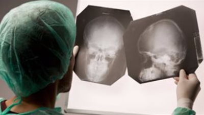 نزيف المخ يحدث دون إنذار.. والإصابة في عمر صغير بسبب عيب خلقي