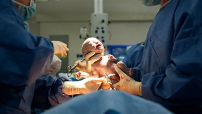 العملية القيصرية السابقة لا تمنع النساء من الولادة الطبيعية