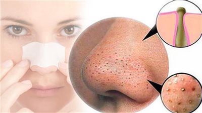 10 طرق لتجنب ظهور الرؤوس السوداء