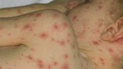 إصابة 15 طالبًا بالجدري المائي في مدرسة السلام بأسيوط