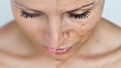  تعرف على أسباب ظهور الكلف على البشرة