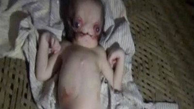 بالفيديو..  ولادة طفل يشبه الكائنات الفضائية