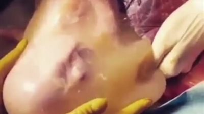 بالفيديو.. أغرب حالة ولادة فى العالم.. طفل يولد داخل 