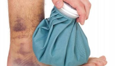 طرق بسيطة لعلاج الكدمات في الجسم