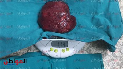 صور| مدير مستشفى أطفال المنصورة: نجحنا في استئصال ورم 