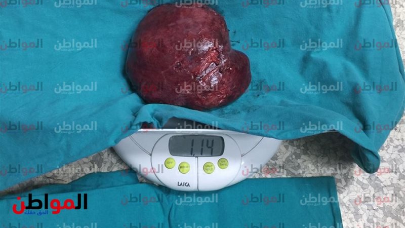 ورم الطفلة جومانه