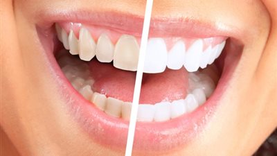 أسهل 5 طرق لتبيض الأسنان في المنزل