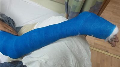 إصابة فني كاميرات في قدمه داخل مستشفى المحلة العام
