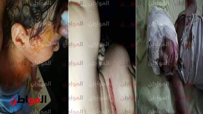 صور.. كلب يهجم على طفلة ويصيبها بـ جراح خطيرة