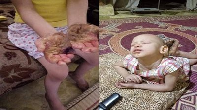 صور.. إستغاثة طفله ينهشها المرض فى صمت دون شعور أحد 