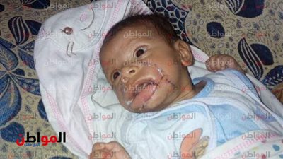 أم تأكل فم ابنها الرضيع والجيران يبحثون عن طبيب تجميل