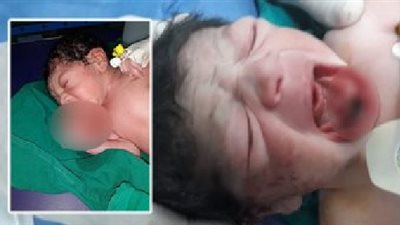 إزالة ورم دموى لطفل عمره ساعة بمستشفى التأمين الصحى بمدينة نصر