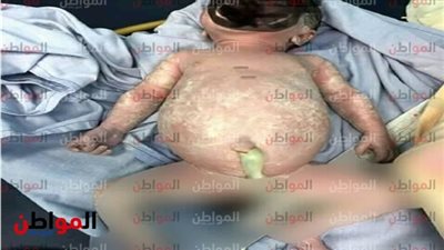 تجهيز طفلة أسيوط الحامل لإجراء جراحة عاجلة لاستئصال الجنين من بطنها