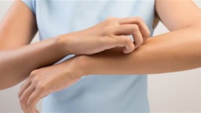  مرضى الحساسية الجلدية