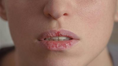 مش عارفة تحطي روج .. 4 عادات خاطئة تسبب تشققات الشفاة
