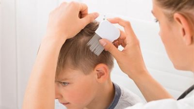 احمي طفلك من مرض الثعلبة واعرفي أعراضه وعلاجه