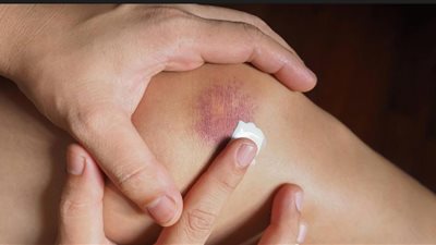«لو اتخبطي».. أفضل 7 زيوت لعلاج الكدمات