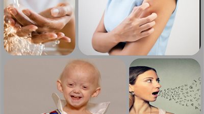 4 أمراض غريبة لم تسمع بها من قبل.. أبرزها هذا المرض