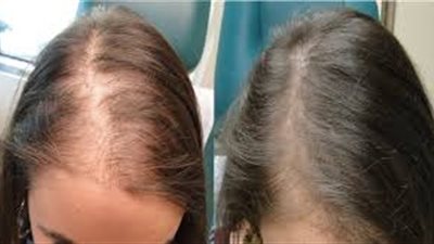 لو عندك صلع.. تعرفي على أسس زراعة الشعر
