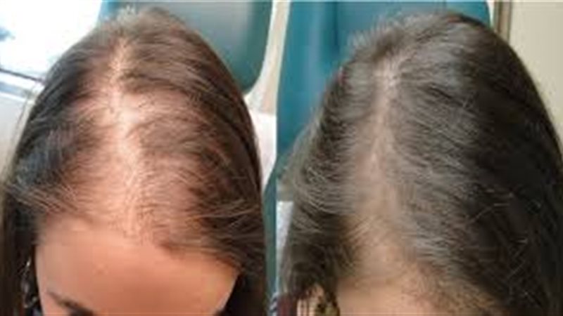 أسس زراعة الشعر