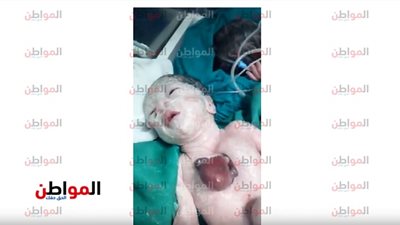 فيديو| حالة نادرة.. «قلب مولودة خارج القفص الصدري» في سوهاج