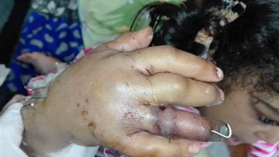 إحالة مديرة مدرسة للتحقيق في واقعة بتر أصابع تلميذة بكفر الزيات
