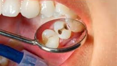 وزارة الصحة توصي بزيارة الطبيب كل 6 شهور لعلاج مشاكل الأسنان