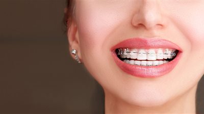 الفلجة بين الأسنان .. طبيب يُوضح أسبابها وطرق علاجها