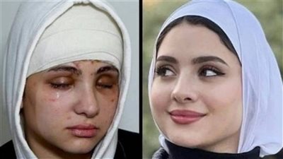 «الشبكية شبه سايحة».. هل البلوجر سارة محمد فقدت بصرها نهائيا؟