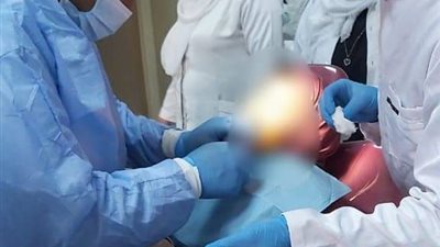 وحدة أسنان الأطفال بمستشفى فاقوس تنجح في إزالة ناسور لطفلة