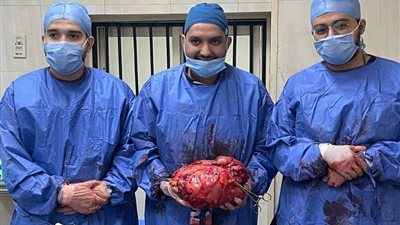 وزنه 12 كيلو جرام.. فريق طبي بجامعة أسيوط ينجح في استئصال ورم بالقولون