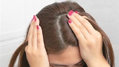 خل التفاح وجوز الهند.. 8 وصفات طبيعية تعالج قشرة الشعر 