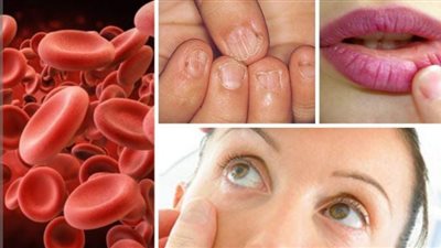 أخصائي تغذية علاجية يكشف أسباب فقر الدم العدو الصامت لصحة المرأة ؟