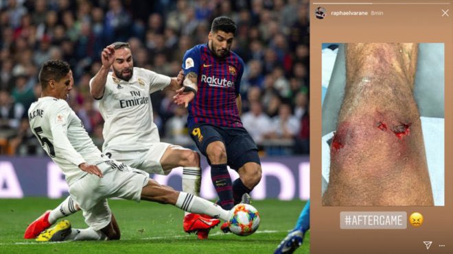 صورة| إصابة دموية لـ«نجم ريال مدريد» في الكلاسيكو