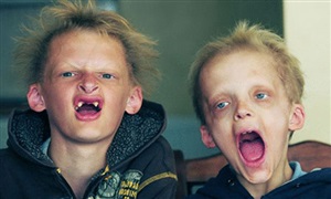 طفلان مصابان بالبورفيريا