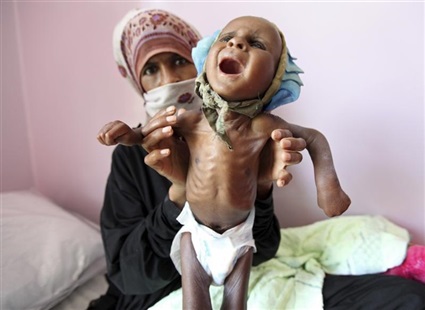 أطفال اليمن .. أزمة